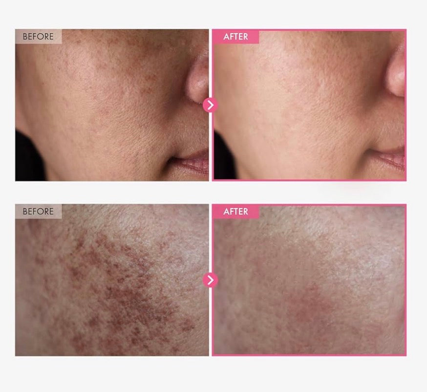 Arbutin Cream Darkspots|Acne| Hyper pigmentation Corrector