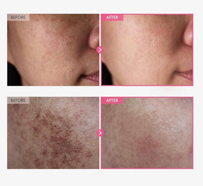 Arbutin Cream Darkspots|Acne| Hyper pigmentation Corrector